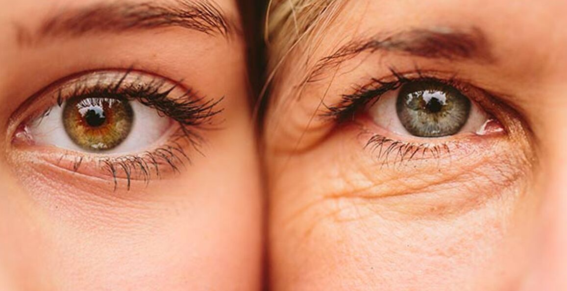 Ihon ikääntymisen ulkoisia merkkejä silmien ympärillä kahdella eri-ikäisellä naisella