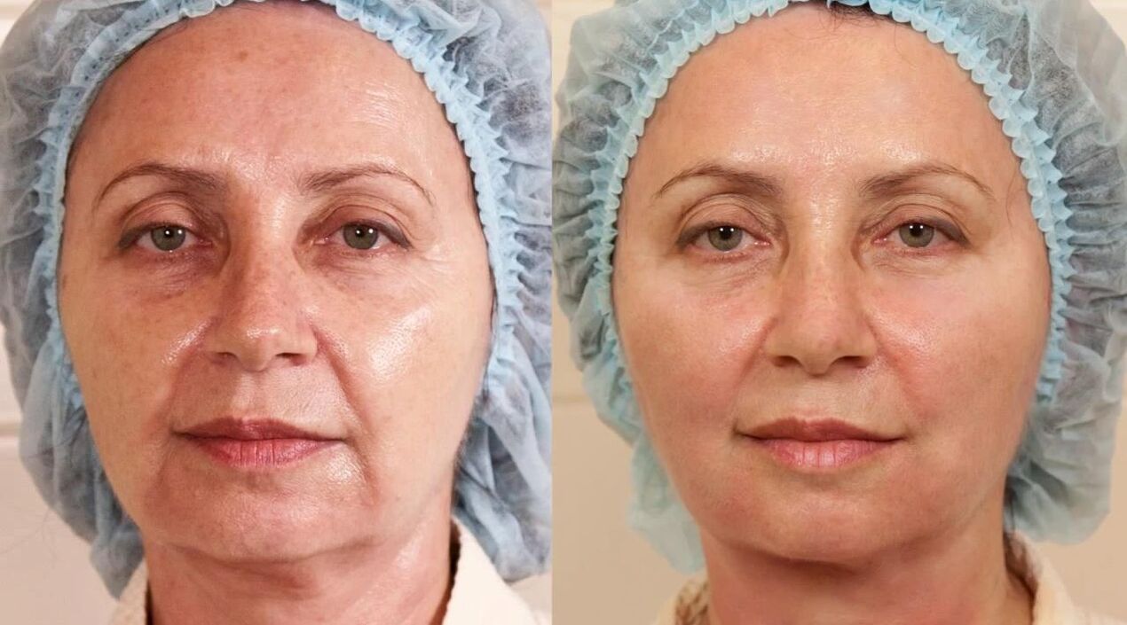 ennen ja jälkeen -kuvia kasvojenkohotuksesta