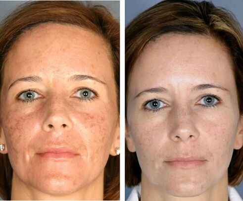 Ennen ja jälkeen kasvojen jakotermolyysi
