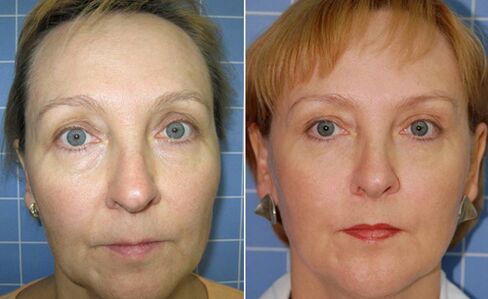 Ennen ja jälkeen kasvojen osittaislaser kasvojen nuorentamista
