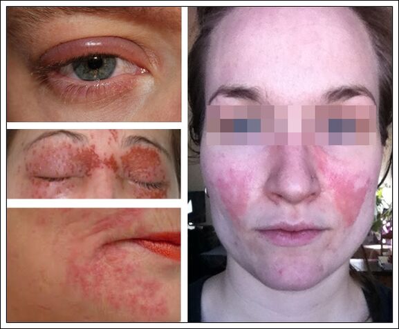allergia anti-aging naamioille